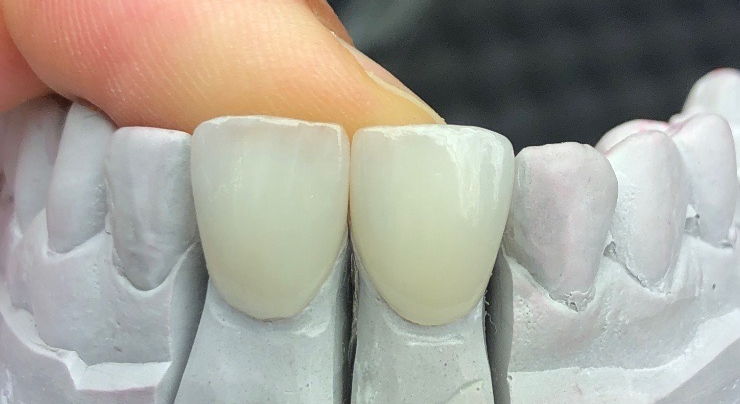 Veneers – Modell