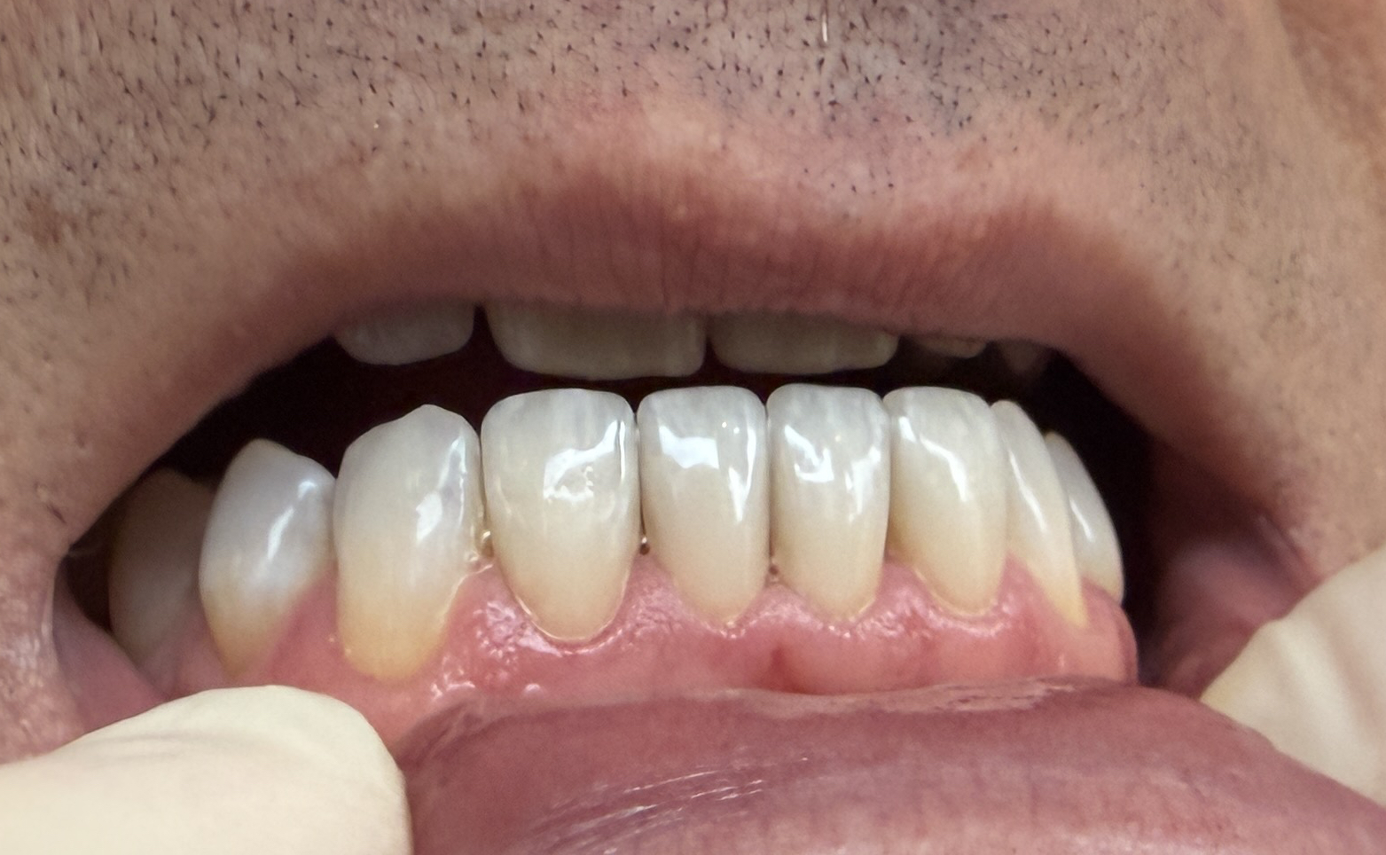 Veneers – Patientenbild Detail