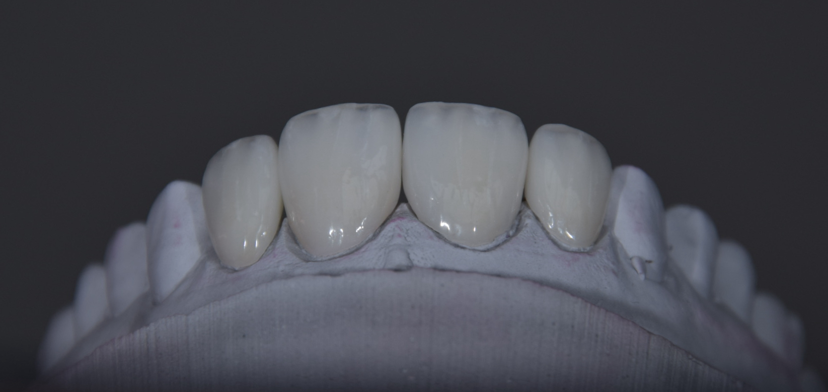 Veneers – Modell 1